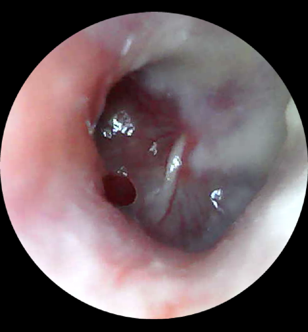 perforazione della membrana timpanica