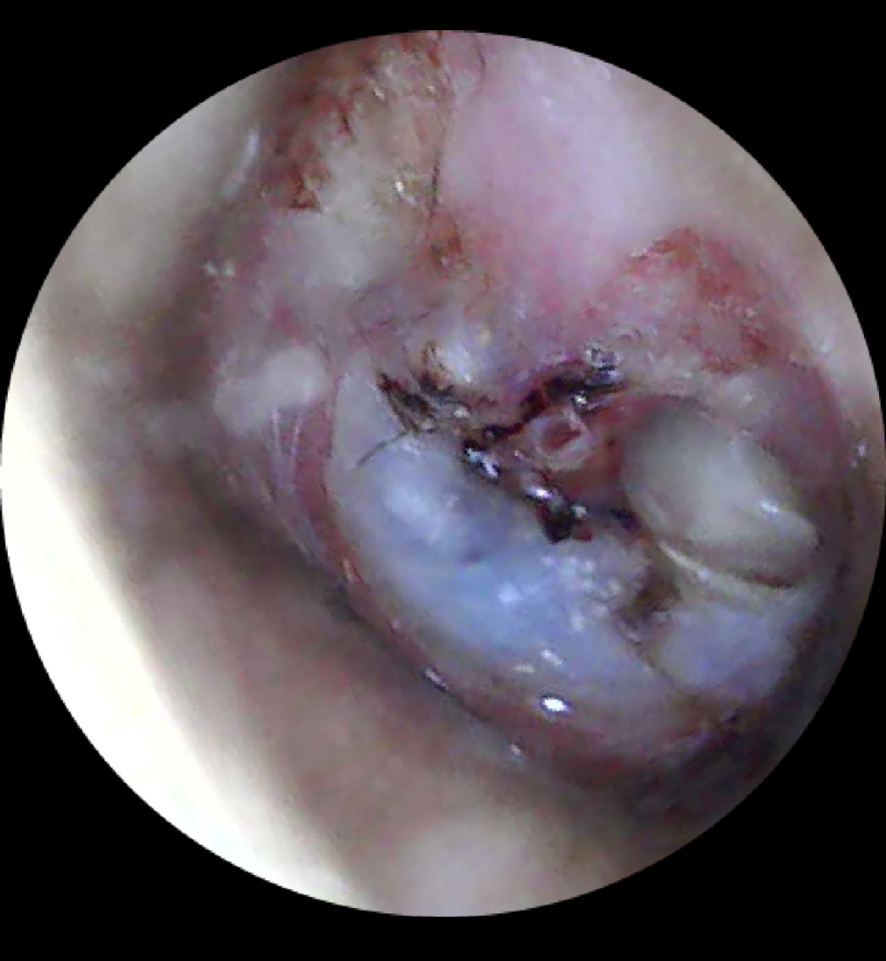 perforazione della membrana timpanica