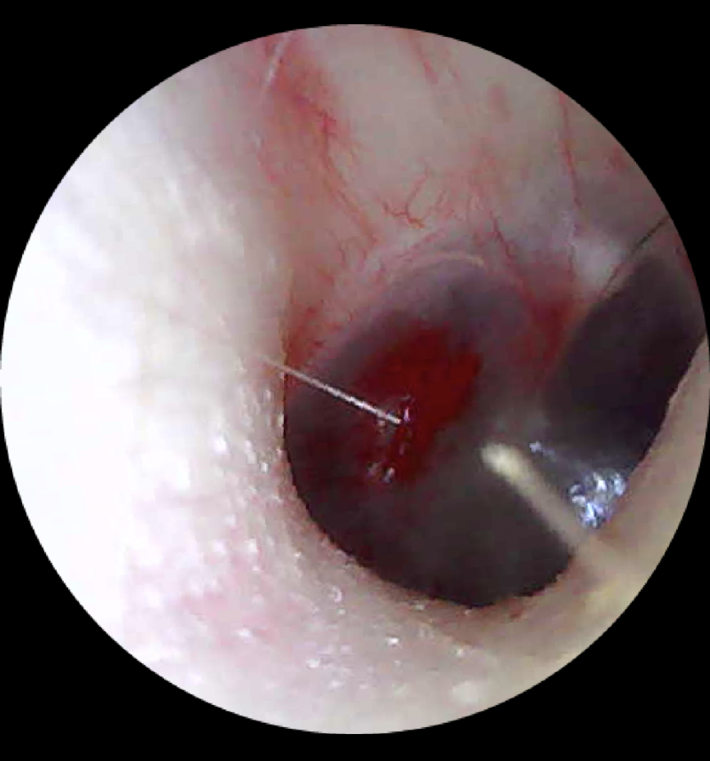 perforazione della membrana timpanica